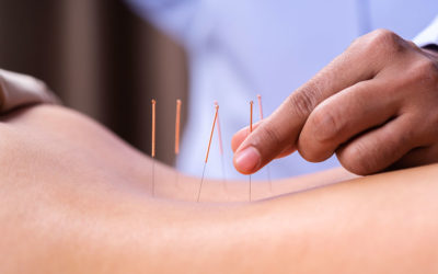 Se soigner au naturel grâce à l’acupuncture