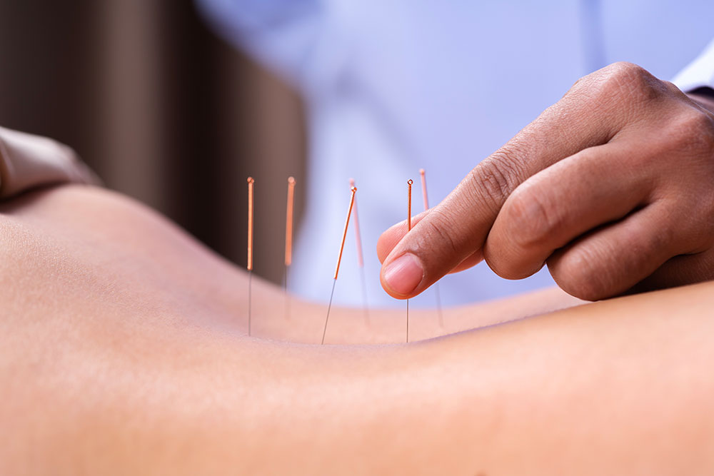 Se soigner au naturel grâce à l’acupuncture